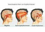 Kopfschmerzen vom Hinterkopf ausstrahlend - Symptome, Ursach